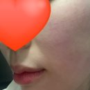 지니텐 | 피부 얇고 얼굴살 없는 타입이 받은 리프팅, 텐써마 솔직 후기