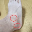 김재우한의원 | [발목인대 파열 회복 후기] 전거비인대 완파, 종비 후거비 부분파열, 골수부종/6주차