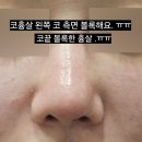 뭉툭 | #코흉살 때문에 코끝 뭉툭해지는 이유 (2회 후기)