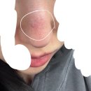 한빛한의원 | 코 성형 두번 수술 후 실리콘 제거 리얼 후기 / 가짜코 탈출