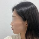 성수피부과 슈링크유니버스 + 볼뉴머 300샷 볼링크 한달후기