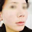 다온냥 | 실리프팅 하실분은 필독 청담피부과 내돈내산 후기 붓기 변화과정