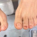 문제성 손, 발 오감네일 이미지