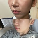 베이스피부과의원 | 강남 피부과 내돈내산 후기, 위코우노 스킨부스터 전후 비교