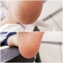 나도 손톱, 레푸스 개봉점