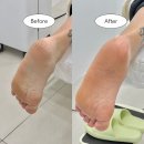 장기역 | 김포발각질 관리 레푸스 김포장기역점 아기발 만든 솔직후기