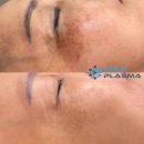 콜드플라즈마 이미지