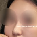 노즈빔 무보형물 코수술 내돈내산 한달차 솔직후기 남기기