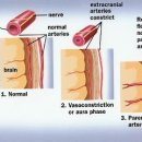 Headaches (Tension type &amp; Migraine) 이미지