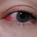 [눈병의종류 & 눈병증상] 여름철 눈병 질환 관리하는법! 이미지