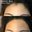 챠밍헤어라인 이미지