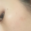 프라우빌딩 | 평택 피부과 흑자,기미 레이저 잘하는 곳 ｜ 소사벌 룩스미의원 루비레이저 피부과 후기