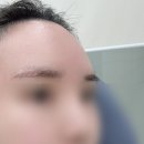 이마로 | 구월동 이마필러 +측두근 보톡스 후기 | 내돈내산 솔직 리뷰