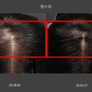 힐강한의원 | 가양동탈모병원에서 리제네라까지 받은 탈모치료 3개월 후기