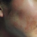 더윤한의원 | 아토피는 시기별로 치료원칙과 예후도 다르답니다.