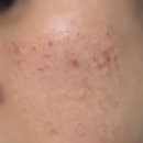 경희최우수한의원 | 금호동 경희최우수한의원 침치료, 스킨부스터 후기