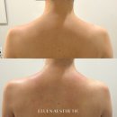 강남피부관리 엘루엔에스테틱 승모근 저자극 필링 후기