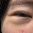 [눈밑지 2주차 후기] 여우눈, 몽고주름, 애교살 사라짐 회복중!