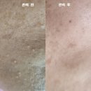 항암 후 “무너진 피부 장벽 스스로 회복하도록 돕는 플라스마 피부관리에 대하여 알아보기
