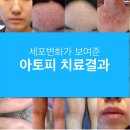체인지유피부과 네이버블로그