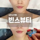 삼계풍림위너스타운 | 김해피부관리 빈스뷰티 슈퍼젝션 내돈내산 솔직 후기