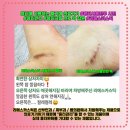 한솔유통의료기기판매업 | [공지] ~8(금)[흉터연고스틱💕리메스카흉터크림] 성형외과 판매중&amp;맘카페난리난 흉터재생연고 :: 성자의...