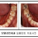 [Q&A] 어금니 임플란트도 심미적으로 가능한가요? 임플란트 가격 은 어떻게 되나요? 이미지