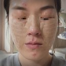 피부이야기1- 기미인줄 알았던 흑자 치료, 라움성형외과 / 완전 만족하는 흑자 레이저 후기 (얼굴사진주의)