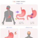 소화불량dyspepsia , 消化不良 , ＜일＞しょうかふりょう 이미지