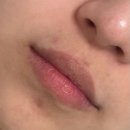 광림약국 | 여드름 연고 흉터 연고 스카덤 클리어 겔, 에스로반 연고 후기, +서현역 저렴한 약국 추천!!