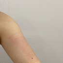 배곧피부과 엘뷰티의원 지방분해주사, 조각주사...주사10cc, 트리플바디, HPL주사) 내돈내산후기 4회완료