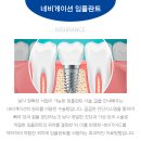 이플란트치과의원 네이버블로그