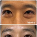 (주)무이디자인 | 강남역 무이성형외과 눈밑지방재배치 한달후기