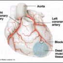 급사(急死)와 관상동맥질환 이미지