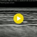 buttock lesions after injection 이미지