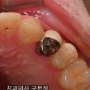 크라운 | 어금니 크라운 깨짐 원인과 PFM 크라운 재신경치료 후기