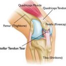 무릎앞쪽통증 슬개건염 치료정보 및 재활운동 (부제 : 알고진행하는 재활보다 좋은 치료는없습니다.) 이미지