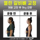 열린갈비 | 성신여대 pt, 열린 갈비뼈 체형 교정 후 9kg 감량 후기