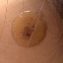 나인의원 | 홍대 나인의원 흑자 제거 후기 / 1년 끝에 드디어 제거 (사진 많음)