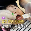 안동제일치과병원 | 27개월 아기 불소도포 후 주의사항과 가격 후기 (안동제일치과병원)