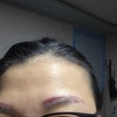 운정뷰티 마가제이 실패한 눈썹문신 1차부터 3차 잔흔제거한 후기