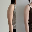 덕지 | 대구 팔 지방분해주사 2회차 통증 붓기 멍 후기