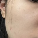 [평택피부관리] 늘미쁨스킨 좁쌀여드름압출(feat. 평택여드름압출, 모공클리닝, 평택좁쌀여드름)
