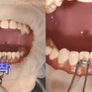 투명교정후기 찾아보며 고민한다면