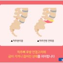 척추분리증 증상 수술해야 하는 경우는? 이미지