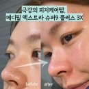 정화 슈퍼 | 블랙헤드 고민 싹 - 메디필엑스트라슈퍼9플러스3X피지연화제 사용후기 가격정보