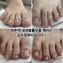 내성발톱발톱무좀관리김수정뷰티 이미지
