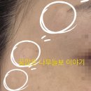 6월. 코어톡스 보톡스 시술 후기. 의사가 서서 주사 놓아주네? 눈 아래도 놓네? 쿨링도 해주네?