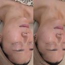 임.이공간연구소 | 울산웨딩관리 노진희피부연구소 울산남구점, 리프팅 온다 x 써마튠 리프팅 관리 후기