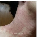 (주)제스통상 | 한의사의 자식이 아토피가 있다면? (춘천피부질환한의원이 자외선 조사기 쓰는 이유)